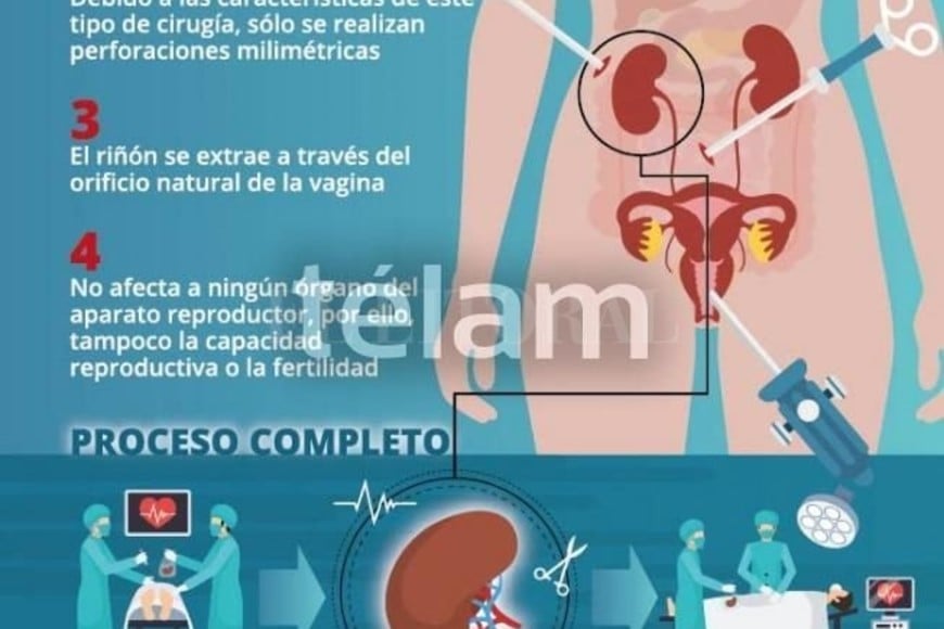 Realizaron La Extracci N De Un Ri N Para Trasplante Por V A Vaginal De