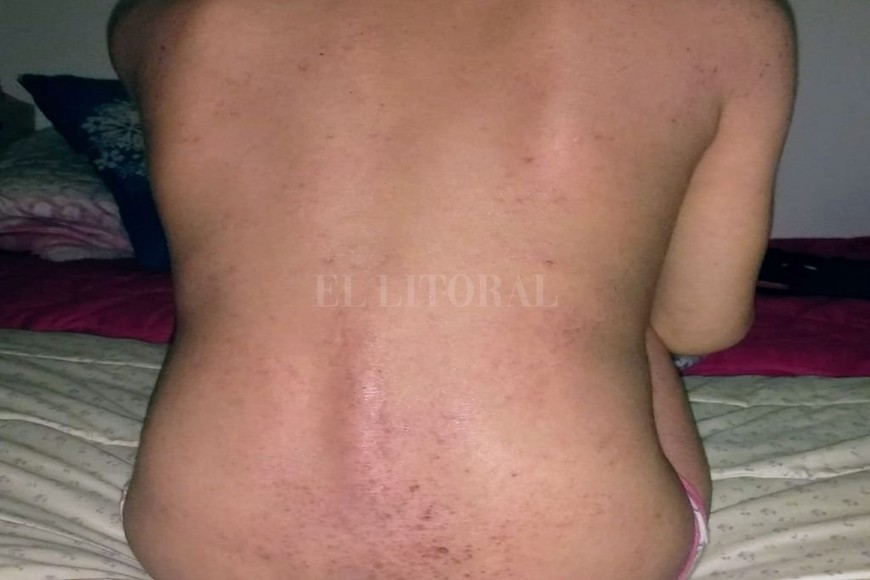 ELLITORAL_273291 |  Gentileza Marcas. La dermatitis atópica deja en sus pacientes marcas producto de la picazón persistente.