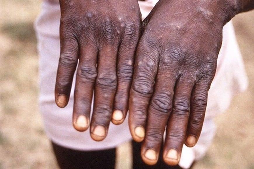 Monkeypox: they call for containment of the global epidemic