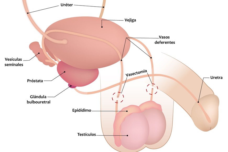 vasectomia