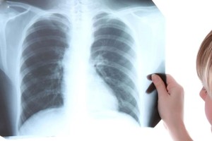 La tuberculosis afecta en especial a la población adulta joven y económicamente activa.