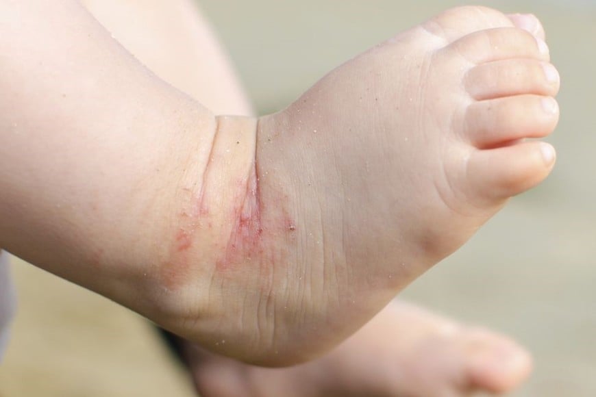 La dermatitis atópica afecta aproximadamente al 15-25% de niños y adolescentes