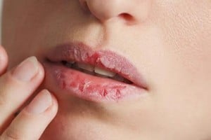 La resequedad de los labios es más común durante la temporada de frío debido a las condiciones climáticas adversas.