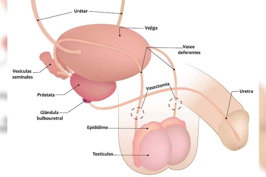 vasectomia