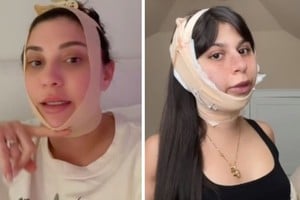 La fiebre de las cirugías estéticas, que una vez tuvo a la Brazilian Butt Lift en su apogeo, cede paso a una nueva tendencia: el 'Chin BBL'