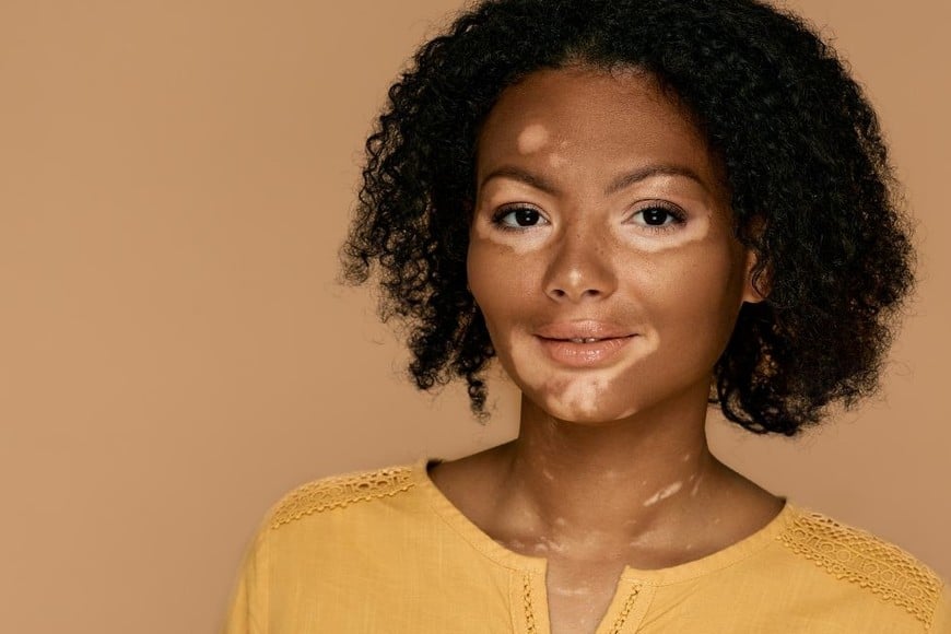 El vitiligo es una enfermedad cutánea crónica que ocasiona un trastorno en la pigmentación de la piel