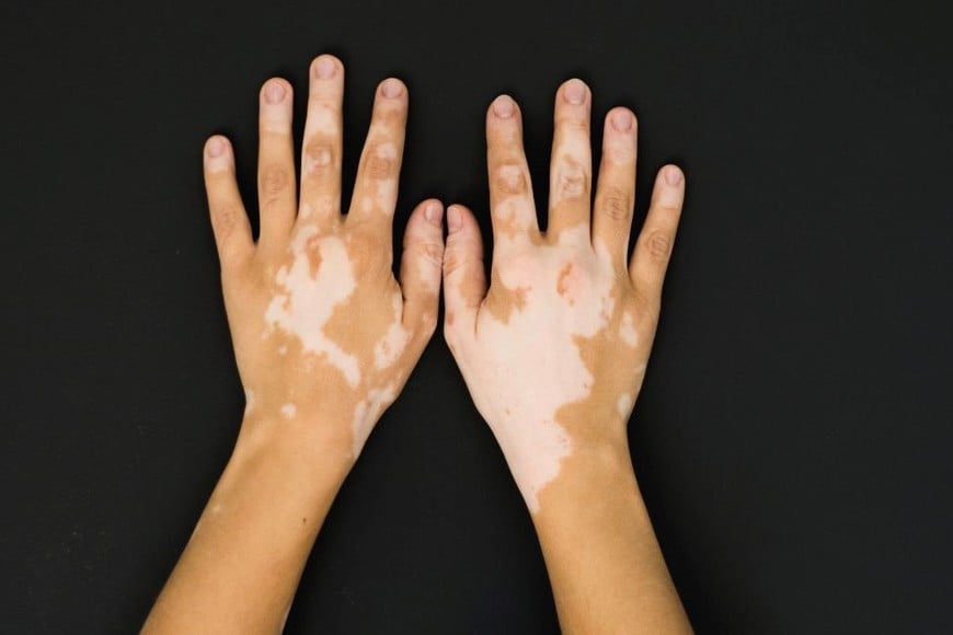 El diagnóstico del vitiligo se realiza clínicamente