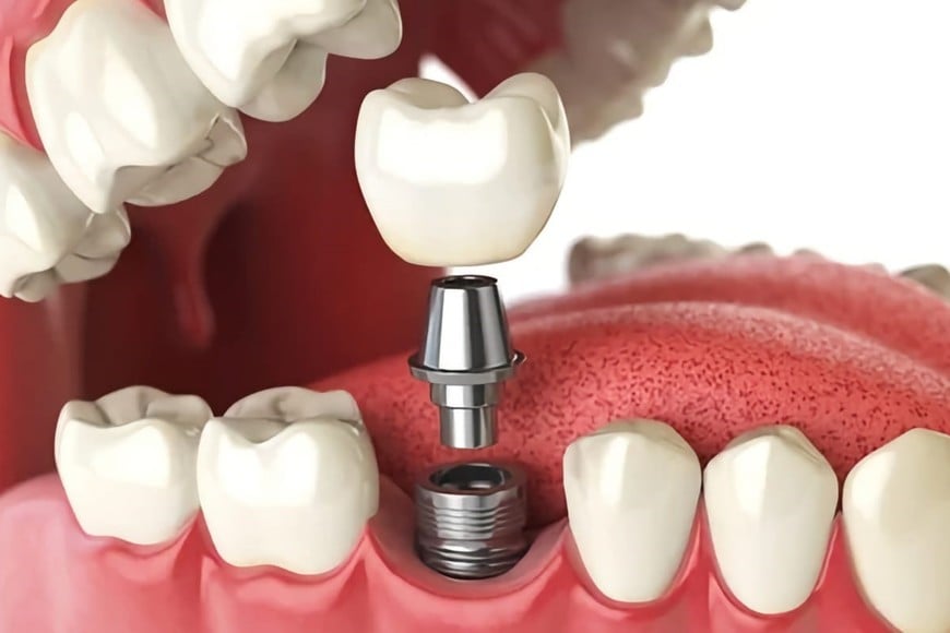 Los científicos esperan eliminar los implantes dentales.