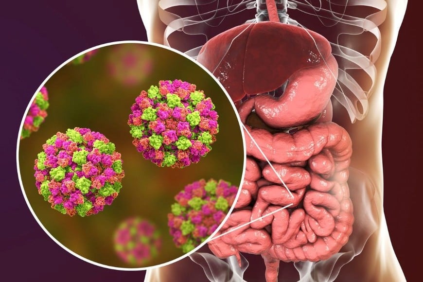 El norovirus causa gastroenteritis, la cual provoca inflamación en el estómago y los intestinos.