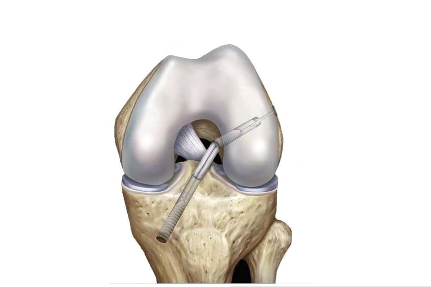 El tornillo es utilizado comúnmente en intervenciones quirúrgicas para la fijación de ligamentos.