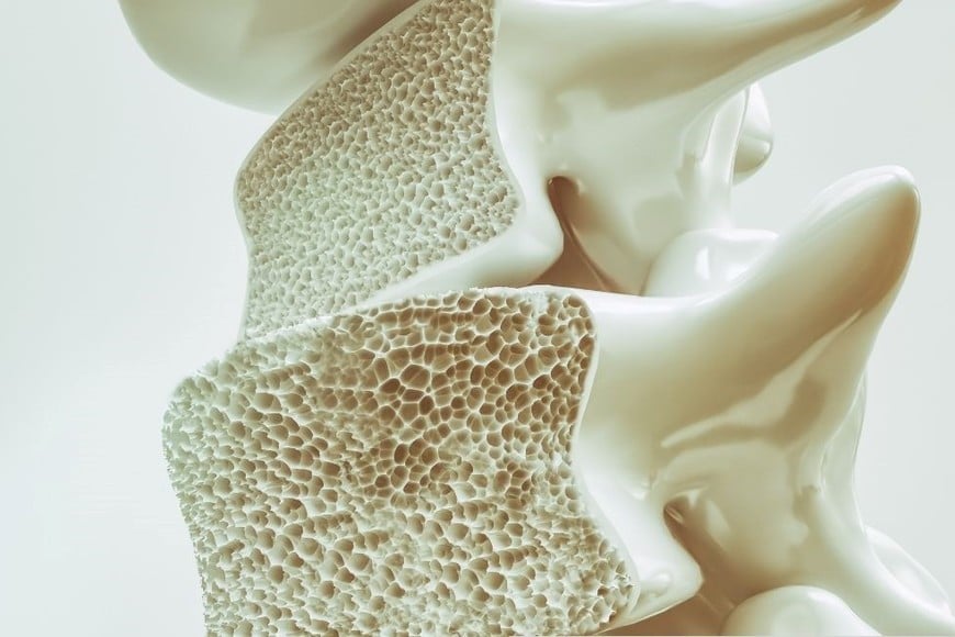 Osteoporosis, significa "hueso poroso", es una enfermedad que reduce tanto la densidad como la calidad de los huesos.