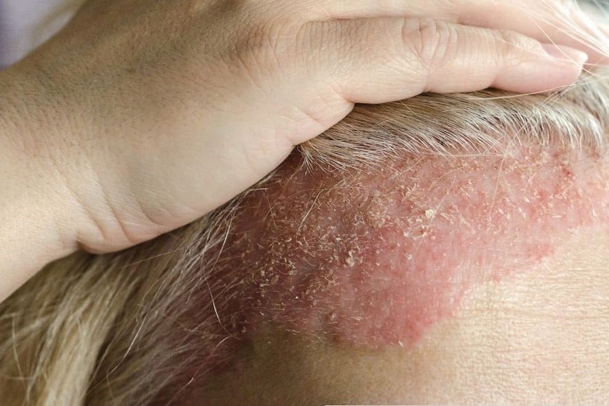 La psoriasis se da más frecuentemente en zonas como codos, rodillas, cuero cabelludo y la parte baja de la espalda.