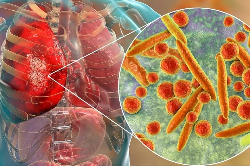 La neumonía es una infección respiratoria aguda que genera inflamación en los pulmones.