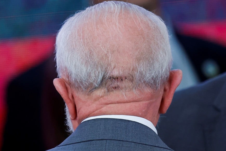 FILE PHOTO: A view shows an injury on the head of Brazilian President Luiz Inacio Lula da Silva, during a signing ceremony for a compensation agreement mining companies Vale and BHP Brazilian authorities, related to the 2015 Mariana dam collapse in southeastern Brazil, at the Planalto Palace in Brasilia, Brazil, October 25, 2024. REUTERS/Adriano Machado/File Photo