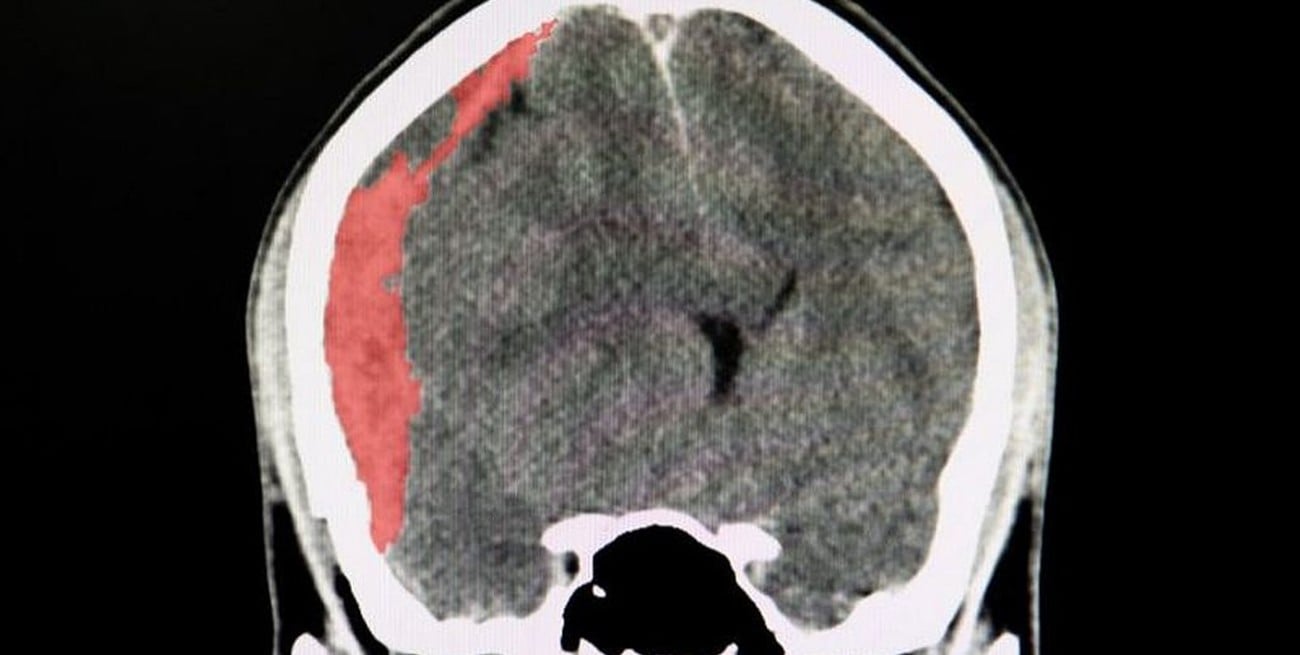 ¿Qué es el hematoma subdural crónico que afecta a Diego Maradona?