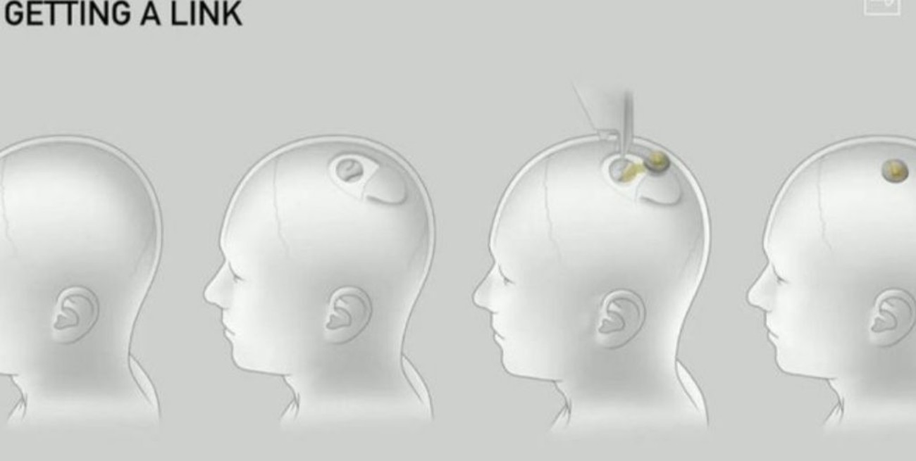 El chip desarrollado por Elon Musk, podría comenzar a ser implantado en cerebros humanos